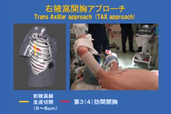 低侵襲心臓手術(MICS) – 岩手医科大学附属病院ハートセンター